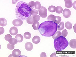 Acute Leukemia resized 600