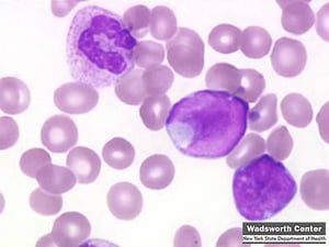 Acute Leukemia