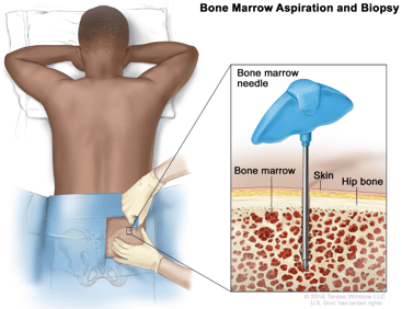 Bone Marrow Aspiration and Biopsy 